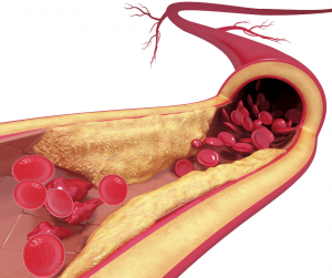 coronary artery with plaques